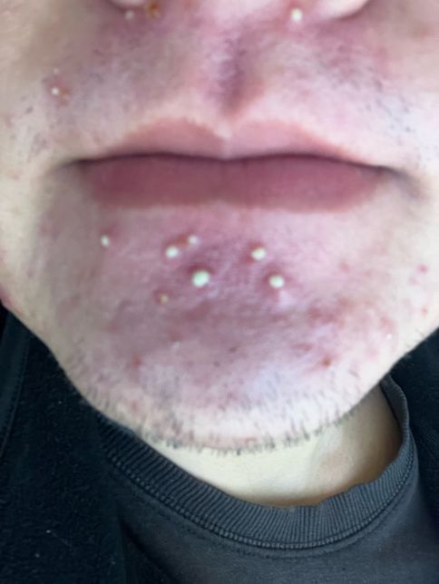 모낭염 미노씬 장기복용과 에스로반 연고사용의 0번 째 이미지