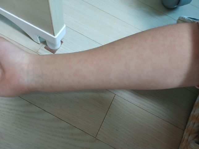 두드러기가 약을 먹었는데도 점점 심해져요의 0번 째 이미지