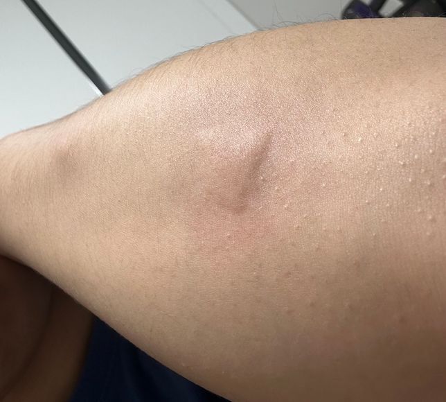 이거 모기 물린건가요? 너무 부어서요의 0번 째 이미지