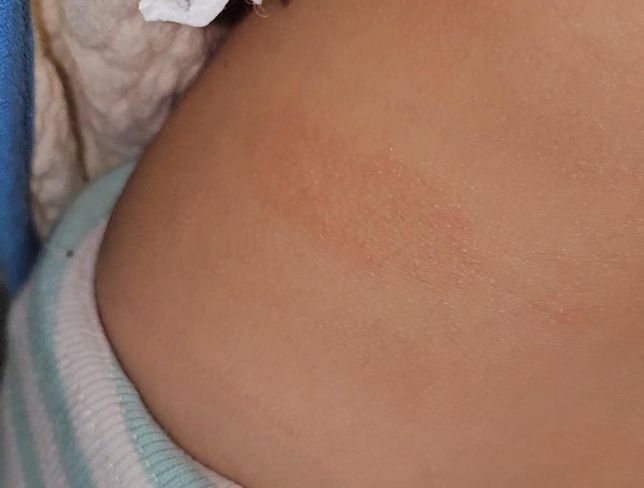 디판테놀 연고, 아토패치 같이 사용해도 되나요??의 1번 째 이미지