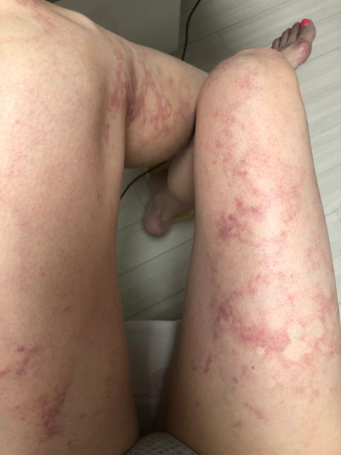 스테로이드 부작용 맞나요. 어쩌죠?의 0번 째 이미지