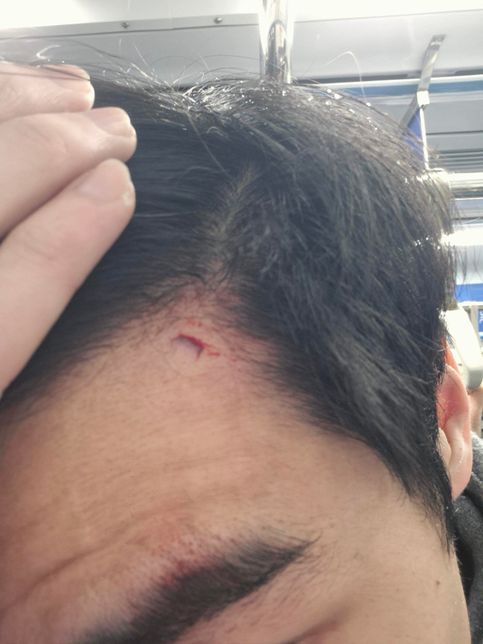 버스에서 앉아있다가 유리가 깨져 이마가 찢어졌는데 치료비 외 보상 받을수있나요?의 0번 째 이미지