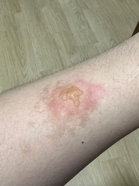 피부과에서 의료사고로 심재성 2도 화상 피해 보상 얼마 청구 해야할까요 ?의 0번 째 이미지