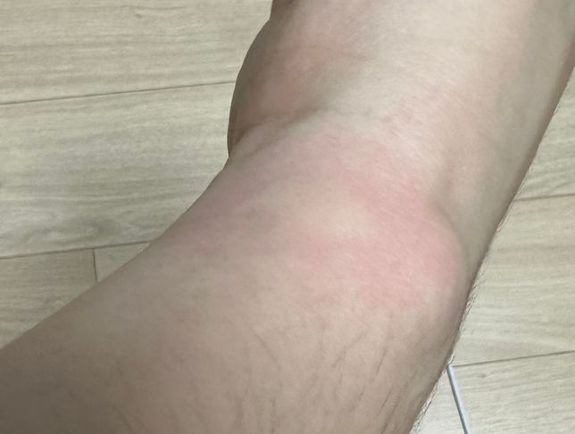 이거 모기 물린건가요? 너무 부어서요의 1번 째 이미지