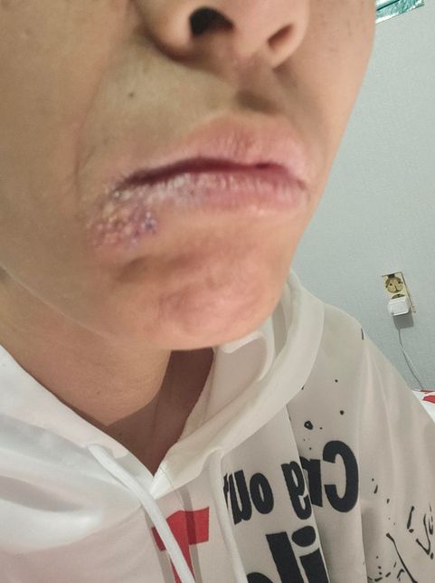 병원가야되나요 피부과모르게네오ㅠ의 0번 째 이미지