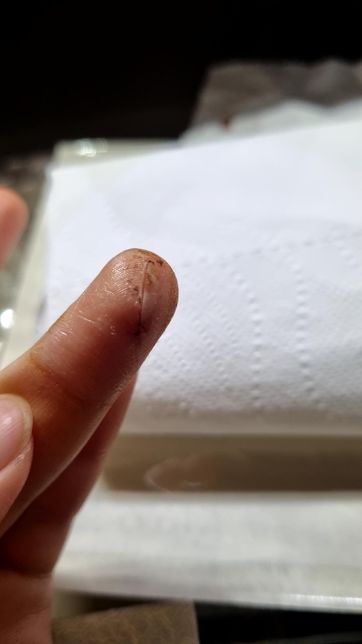 칼에 베인 상처 봉합 필요할까요ㅠㅠㅠㅠ의 1번 째 이미지