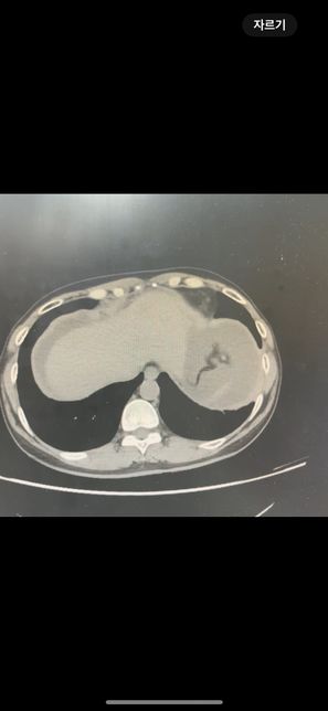 복부 ct 영상 판독부탁드립니다.!의 0번 째 이미지