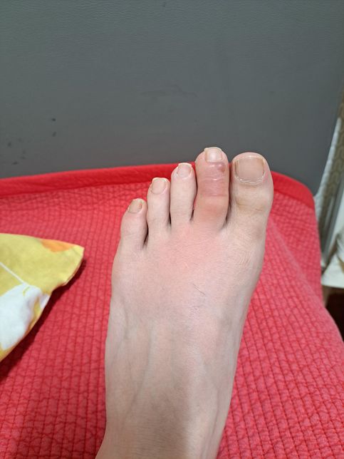 최초에 집에서 지네에 물렸는데 택배라서 응급실가고 주사맞고 약도 먹고 약간부은상태로 일을하는데의 0번 째 이미지