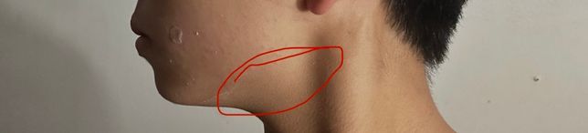 무턱인데 살 빼도 턱선 안생기려나요?의 0번 째 이미지