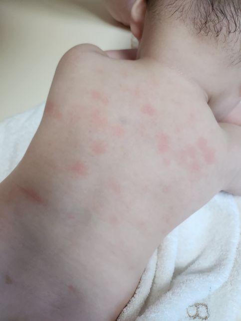 6개월 아기 피부가 왜이럴까요? ㅠㅠ의 0번 째 이미지