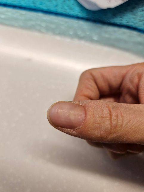 1년째 오른쪽엄지손톱만 울퉁불퉁 합의 0번 째 이미지