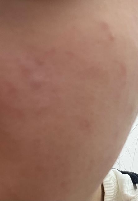 양쪽 볼 피부 트러블 약국 약 질문드립니다의 1번 째 이미지