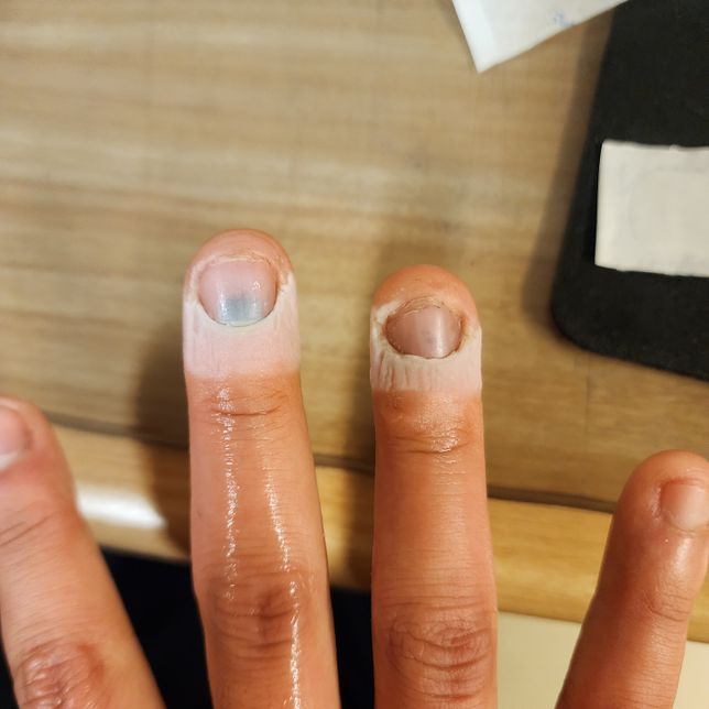 (긴급) 손톱 멍 셀프 드릴링에 대해 알려주세요의 0번 째 이미지