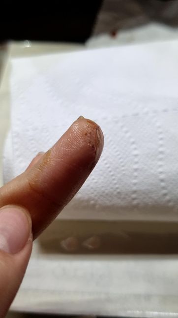 칼에 베인 상처 봉합 필요할까요ㅠㅠㅠㅠ의 0번 째 이미지