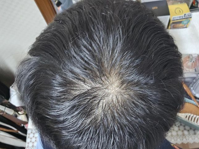 중학교 3학년 인데 정수리가 너무 보여요의 0번 째 이미지