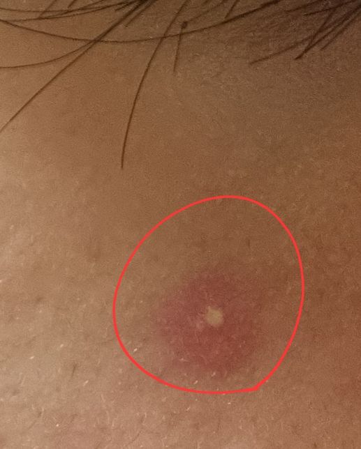 여드름이 계속 그대로 있으면 어떡해야 하나요의 0번 째 이미지