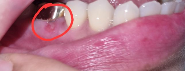 아래 어금니 바깥 쪽 잇몸에 상처 통증이요의 0번 째 이미지