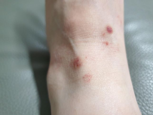 피부좀 봐주세요. 왜 이러는걸까요? 5월부터 시작되었어요의 1번 째 이미지