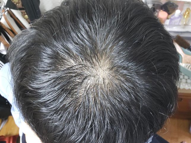 중학교 3학년 인데 정수리가 너무 보여요의 1번 째 이미지