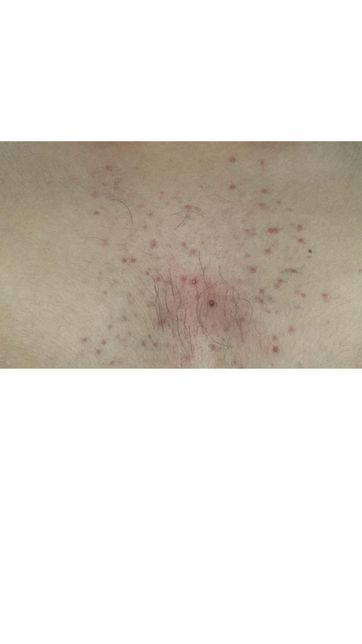 스테로이드제 약 복용후 피부가 뒤집어졋어요..의 0번 째 이미지