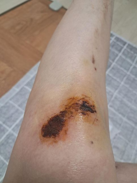 무릎찰과상인데 상처 괜찮은지 봐주세요의 0번 째 이미지