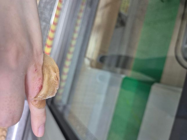 살이 까진 경우도 산재처리 가능할까요?의 2번 째 이미지