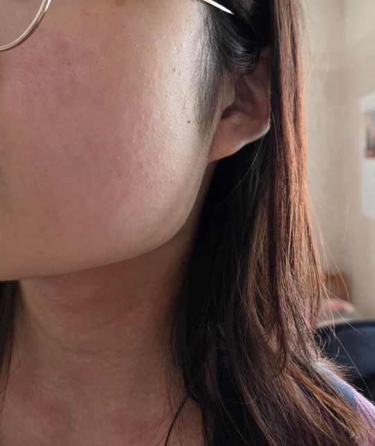 편도염약먹고 알레르기생긴거같은데요ㅠㅠ의 2번 째 이미지