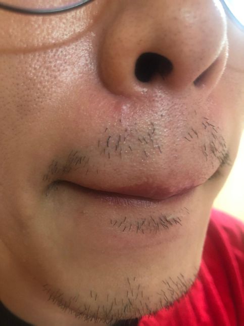 오른쪽 코 밑 모낭염에 관해서 질문드릴게 있습니다.의 0번 째 이미지