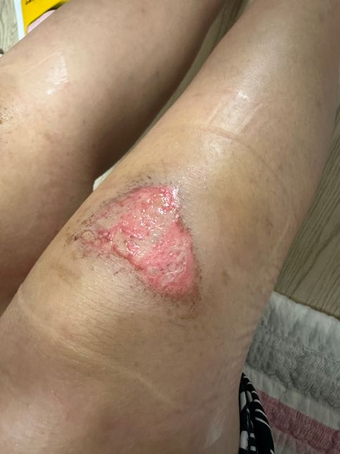 바스포 연고 7일 이상 쓰면 안되나요?의 0번 째 이미지