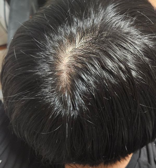 25세 남성 머리카락이 너무 많이 빠지는데 탈모일까요?의 0번 째 이미지