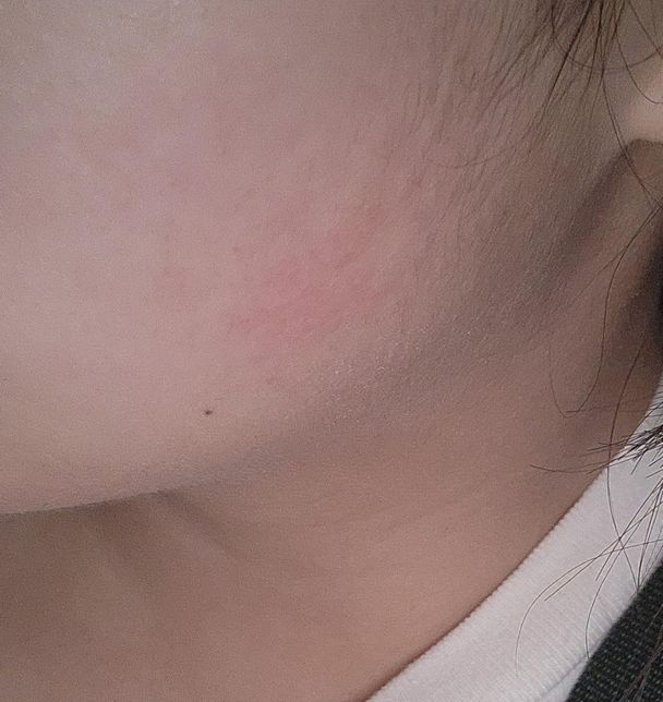 단거먹을때마다 피부에 염증(?)이 올라오네요의 0번 째 이미지