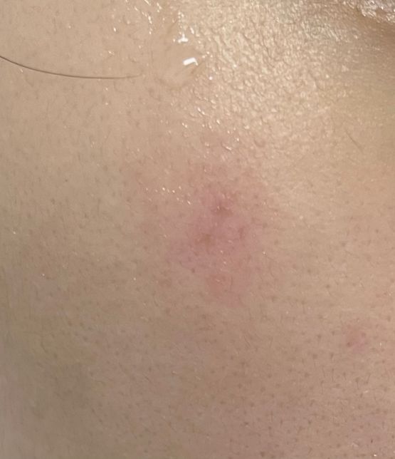 모기 물린곳이 덧났는데 어떻게 해야하나요?의 0번 째 이미지