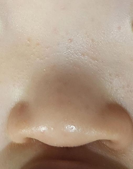 아기 코에 좁쌀만 한 땀띠같은 것들이 나는데의 0번 째 이미지