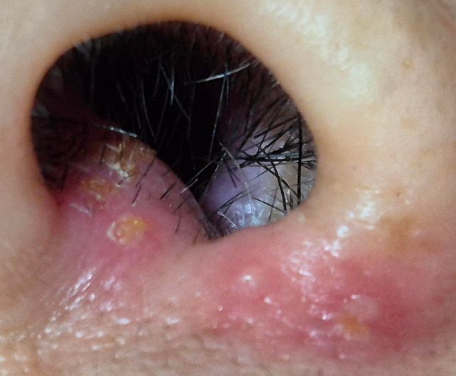 코 안 물집 또는 뾰루지 관련 질문드려요의 0번 째 이미지