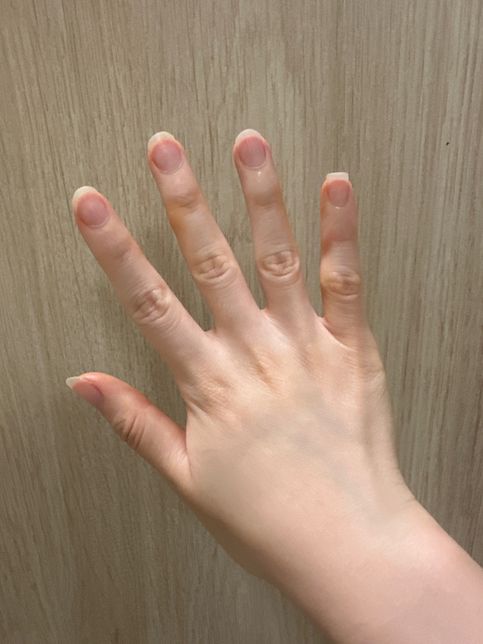갑자기 손이 노란빛으로 변할 수 가 있나요?의 3번 째 이미지