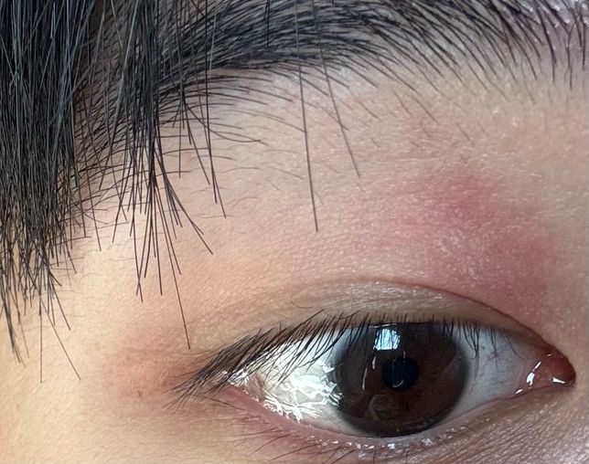 저번에도 사진처럼 두드러기? 아토피처럼 빨갛고 심해지면 쬬루지 하나정도 났는데의 1번 째 이미지