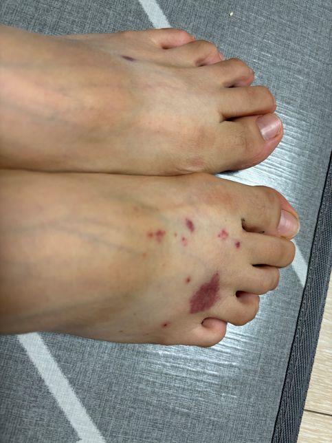 발등, 다리에 이렇게 뭐가 났어요..! 이게 뭘까요?의 0번 째 이미지