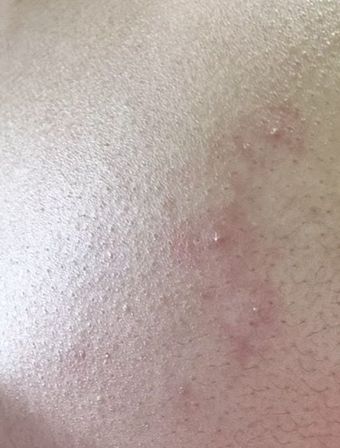 가슴쪽에 뾰로지?같은게 3개가 났어요의 0번 째 이미지