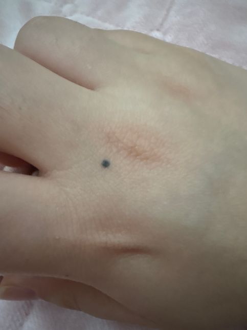 손에 2-3년전에 생긴 검은 점 그럴 수 있는 건가요?의 0번 째 이미지