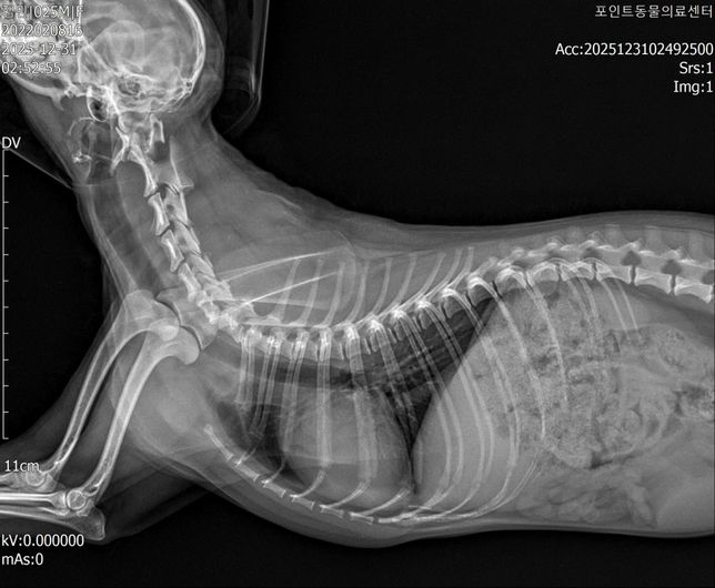 척수증, 척수연화증 판정 받았습니다만, 제가 저희 아이 CT사진을 확인했을때 환축추아(AAI)로도 의심해볼 수 있을거같은데 도움이 필요합니다,,의 0번 째 이미지