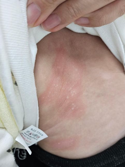 이유식 새로운 재료 추가할때마다 3일차에 알러지가 나타나요의 0번 째 이미지