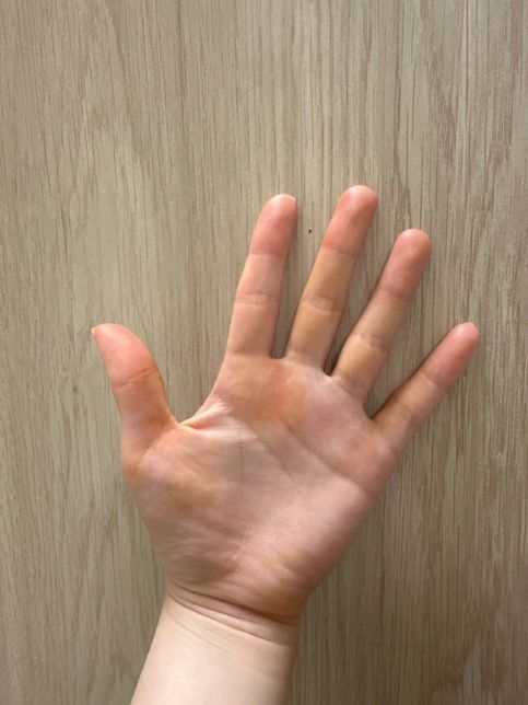 갑자기 손이 노란빛으로 변할 수 가 있나요?의 0번 째 이미지