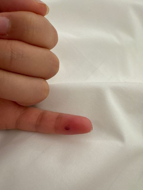 피가 고인 상처 어떻게 해야하나여???의 0번 째 이미지