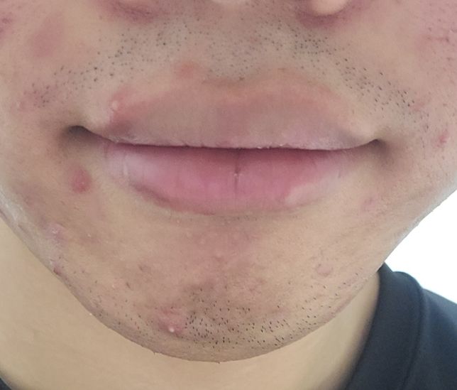 고1인데 수염자국이 너무 심합니다.의 0번 째 이미지