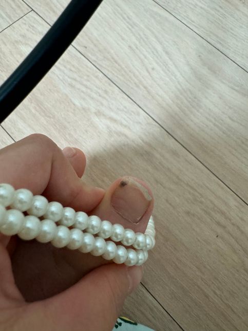 발톱 안 멍 도와주세요 ㅠㅠ 빼버렸는데..의 0번 째 이미지