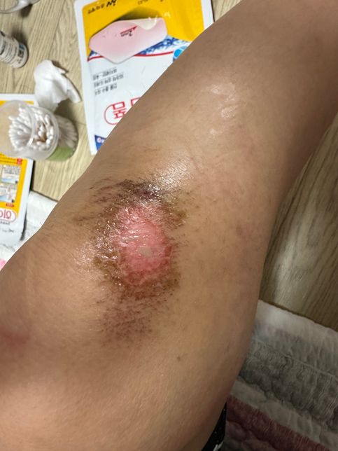 바스포 연고 7일 이상 쓰면 안되나요?의 1번 째 이미지