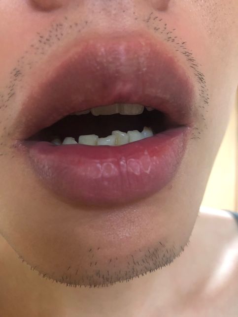 입술 껍질 각질에 관해서 질문드립니다.의 1번 째 이미지