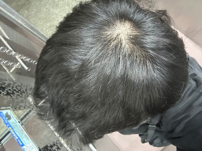 원형 탈모인가요? 탈모 초기맞을까요?!의 0번 째 이미지