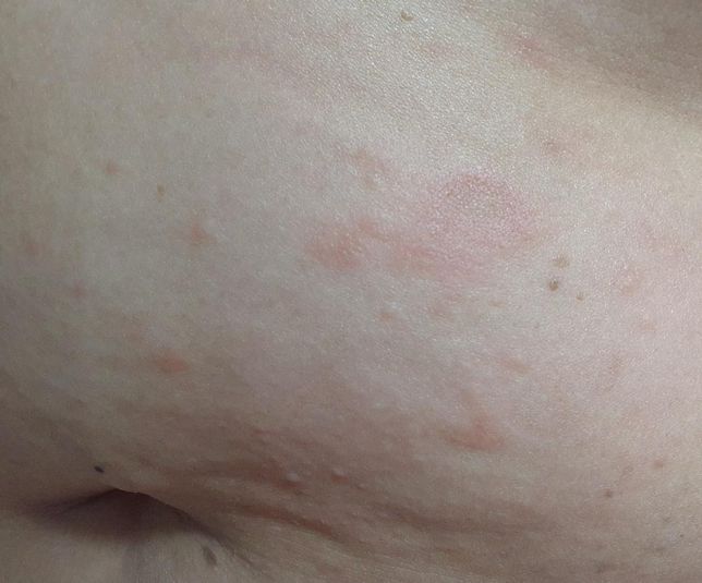 피부 상태에 따른 연고 추천 부탁드립니다의 0번 째 이미지