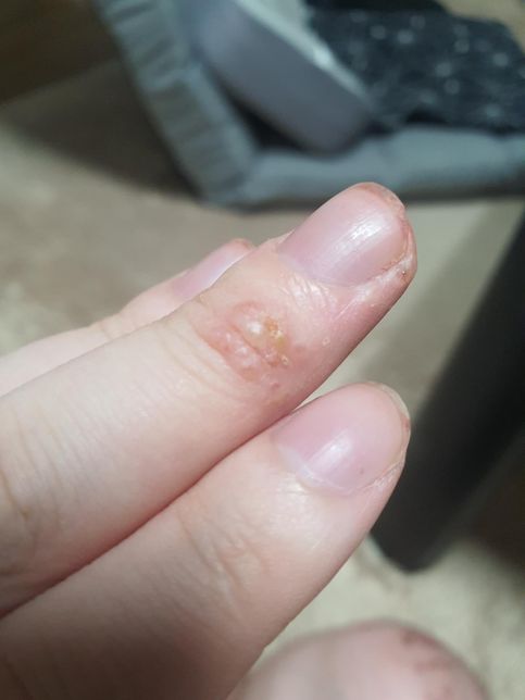 1년이 넘도록 이어진 간지러움 및 피부발진의 2번 째 이미지